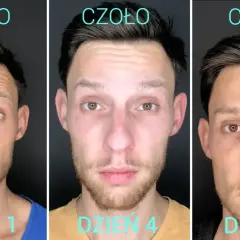 Co ile botoks? Optymalne odstępy i sekrety trwałych efektów