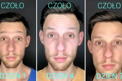 Co ile botoks? Optymalne odstępy i sekrety trwałych efektów