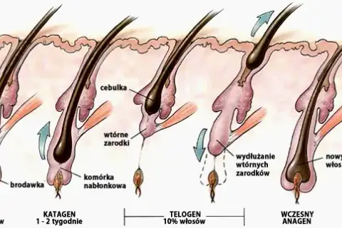 Wypadanie włosów po depilacji laserowej: kiedy i jak to wygląda?