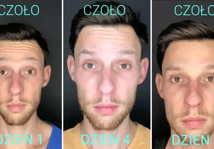Co ile botoks? Optymalne odstępy i sekrety trwałych efektów