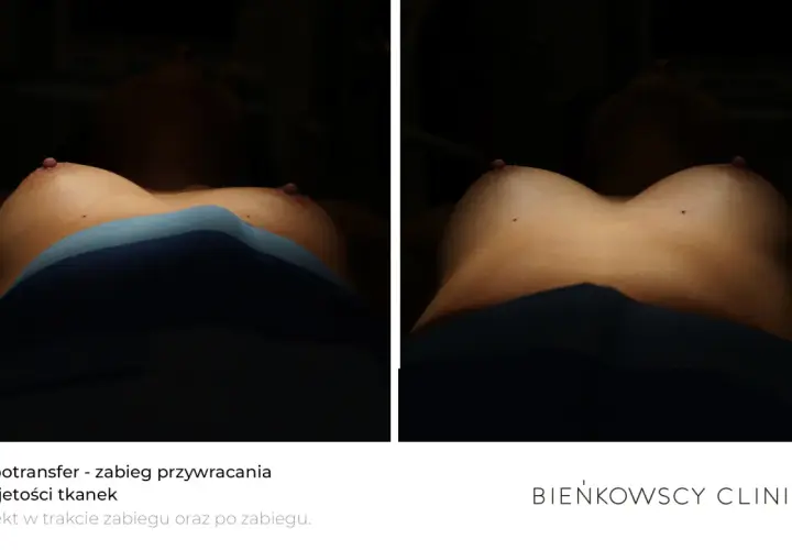 Trwałość lipofillingu biustu: Ile tłuszczu zostanie z Tobą na lata?