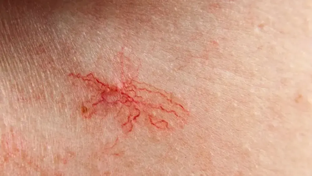 Jak wygląda cera naczynkowa? Rozpoznaj objawy i skutecznie ją pielęgnuj.