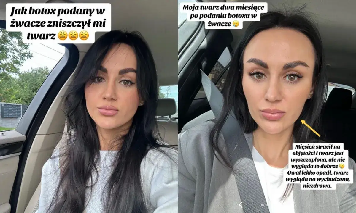 kobieta po zabiegu botoksu z zadowoloną miną