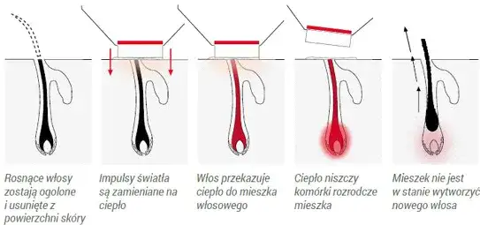 depilacja laserowa mechanizm działania lasera