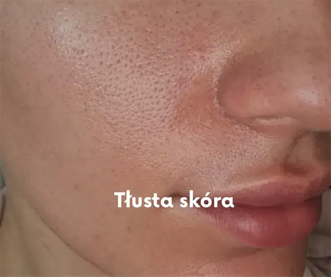 strefa T twarzy gruczoły łojowe