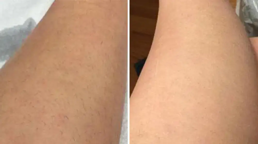 depilacja laserowa nogi przed po