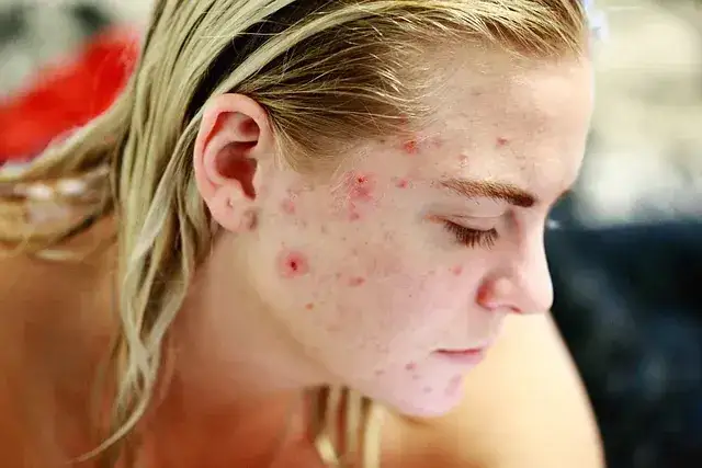 dermatolog konsultacja trądzik